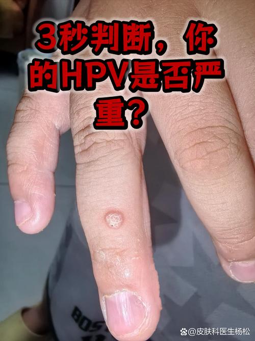hp阳性500严重吗 - 检查hpv阳性是500多严重吗  第1张